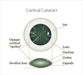 Cortical Cataract