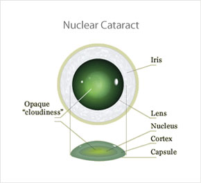 Nuclear Cataract