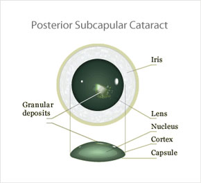 Posterior Cataract